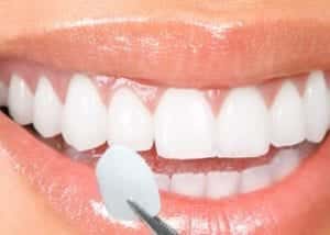 Veneers