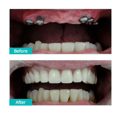 multiple teeth implants dorset